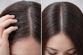 شامپو ضدشوره قوی دارویی از کدام برند بهتر است؟